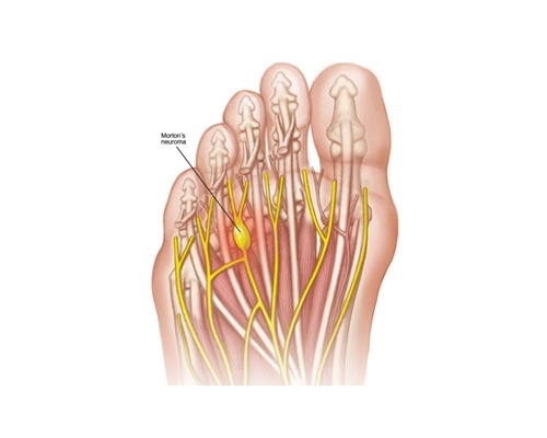 So What Is Morton’s Neuroma?