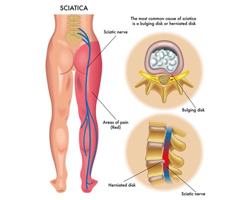 What Is Sciatica?