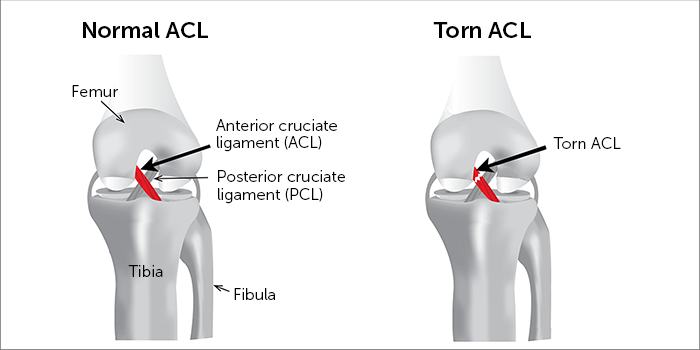 Anterior Cruciate Ligament (ACL) Tear: Symptoms, Causes, Treatment