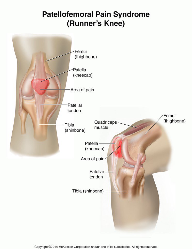 Image result for patellofemoral pain syndrome