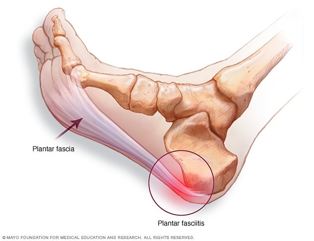 Image result for plantar fasciitis