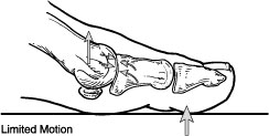 Limited motion of the big toe caused by hallux rigidus